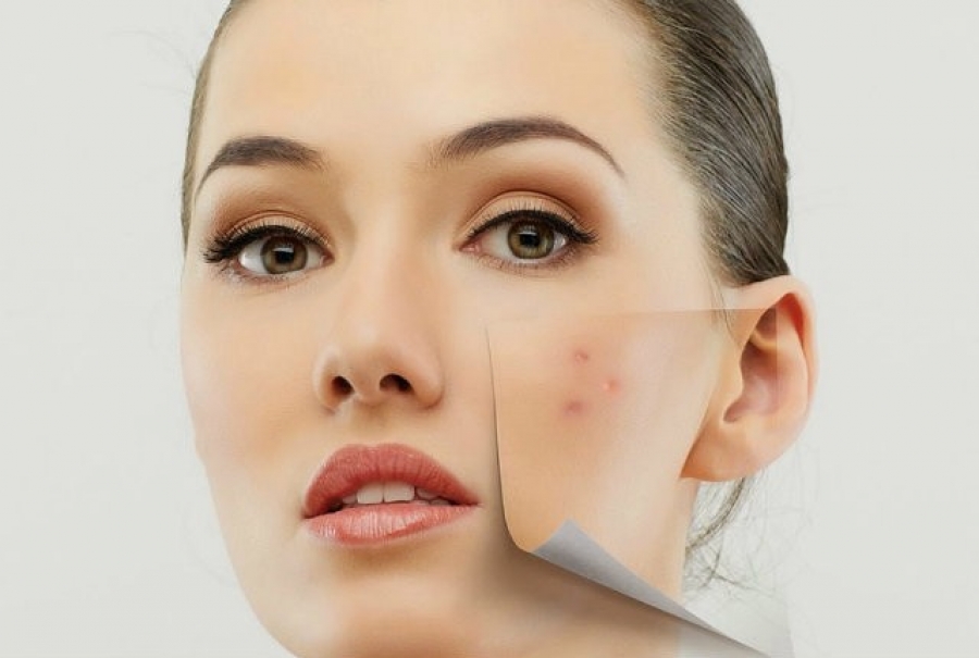 LEOREX PURE — оставьте «прыщики» в прошлом!
